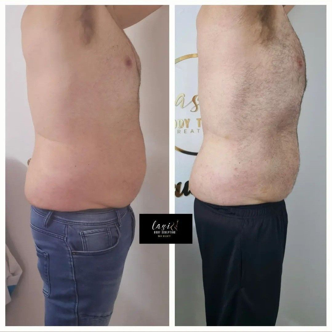 before and after fat dissolving injection images